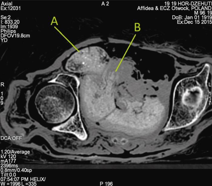 mummy fetus ct0scan