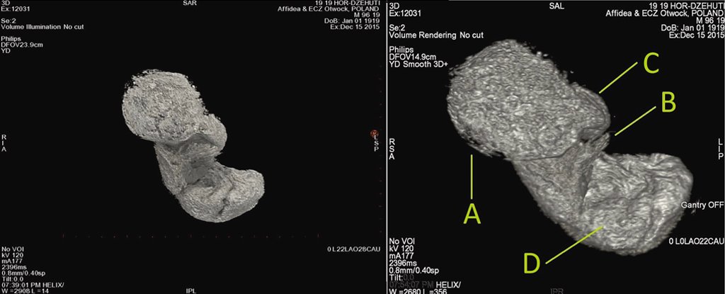 A Fetus Was Preserved Within an Egyptian Mummy Because It 'Pickled', Scientists ..