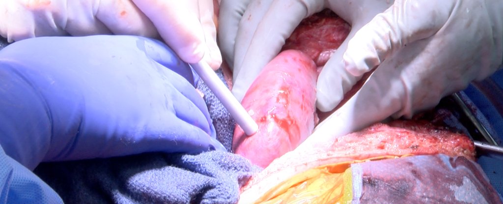 Clinical-Grade Pig Kidney Transplanted Into Human Patient in Scientific First