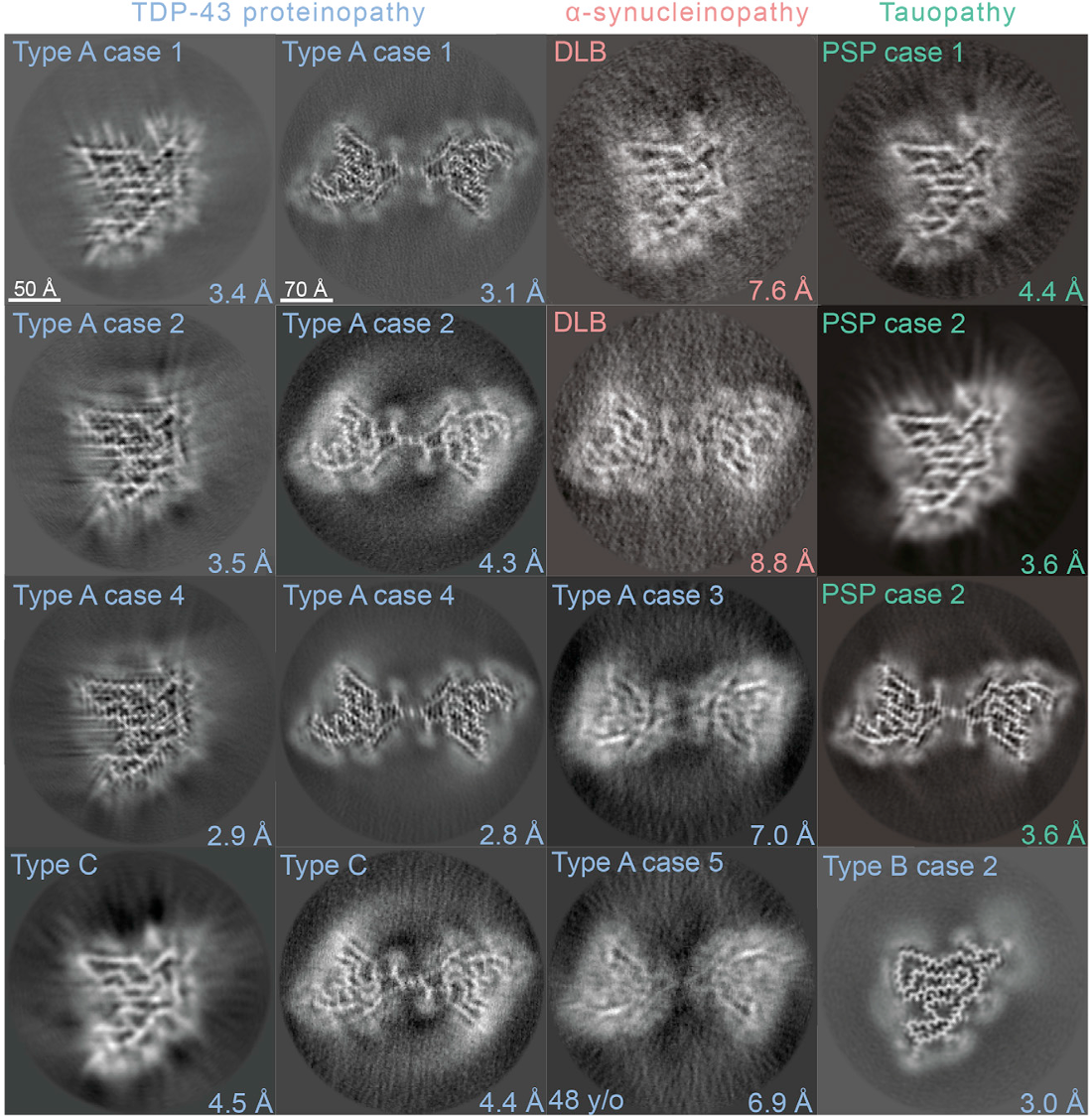 ProteinFibrilsFoundInBrainTissue