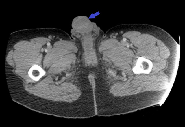 Greyscale image showing a cross section of a male pelvis with organs visible