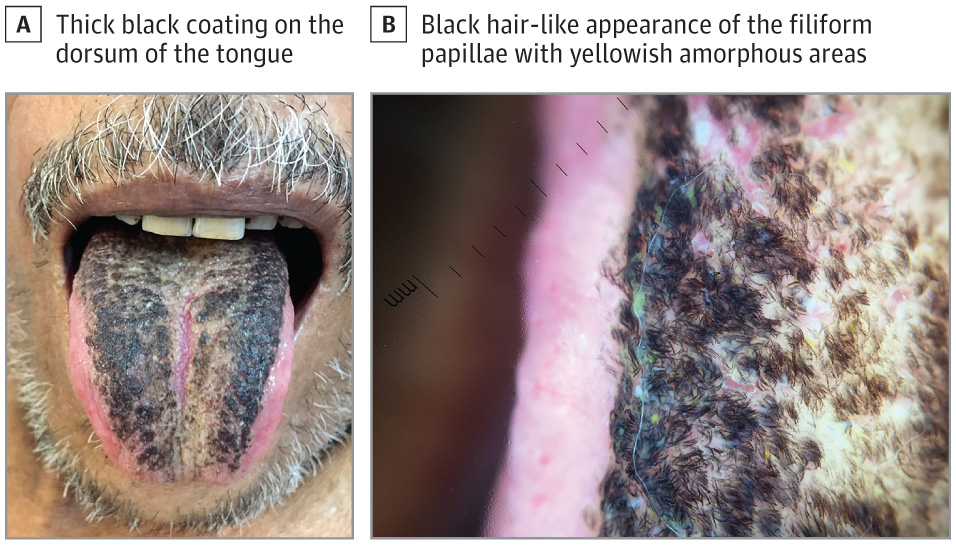 Two side-by-side photos of the black tongue and a microscopic close-up