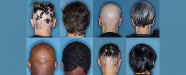 Common arthritis drug offers new hope for treating severe alopecia