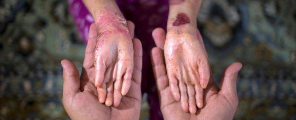 Amazing gel finally brings healing to people with 'butterfly children' disease