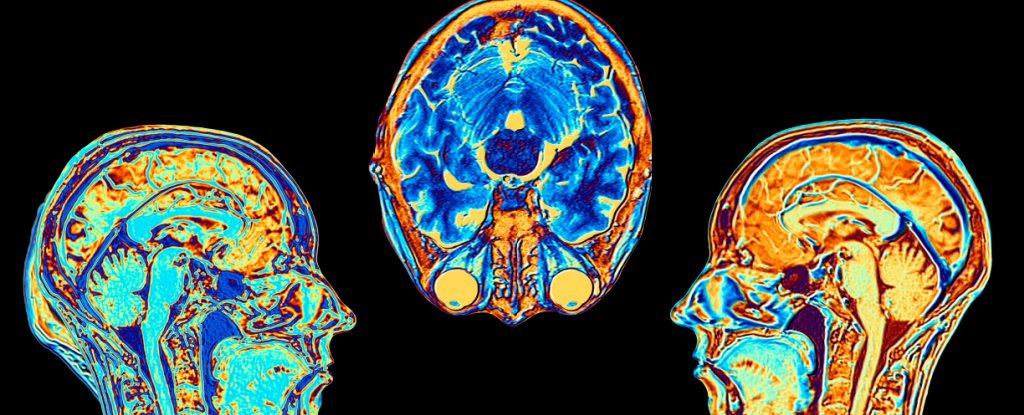 Scans Show Even Mild Cases of Coronavirus Are Linked to Brain Damage