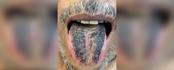 A man had a stroke. Three months later his tongue turned 'hairy' and dark