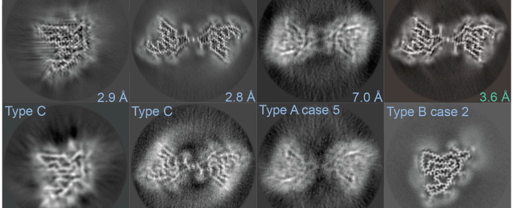 A Common Link Between Several Neurodegenerative Diseases Might Finally Be Identi..