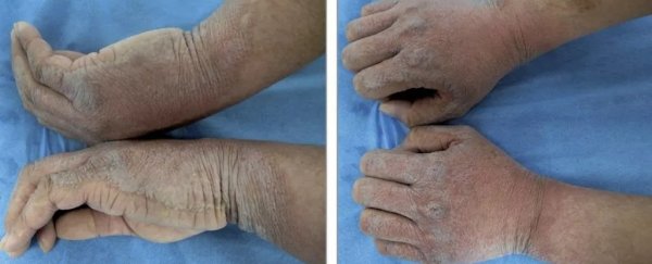 Young man has 'excessive' skin wrinkling from water in incredibly rare medical case