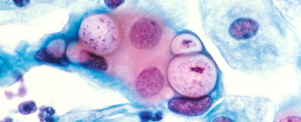 Pap smear showing cells with pink stained vacuoles bloated with chlamydia. 