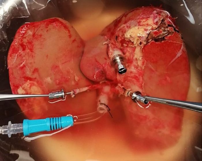 human liver ex vivo perfusion