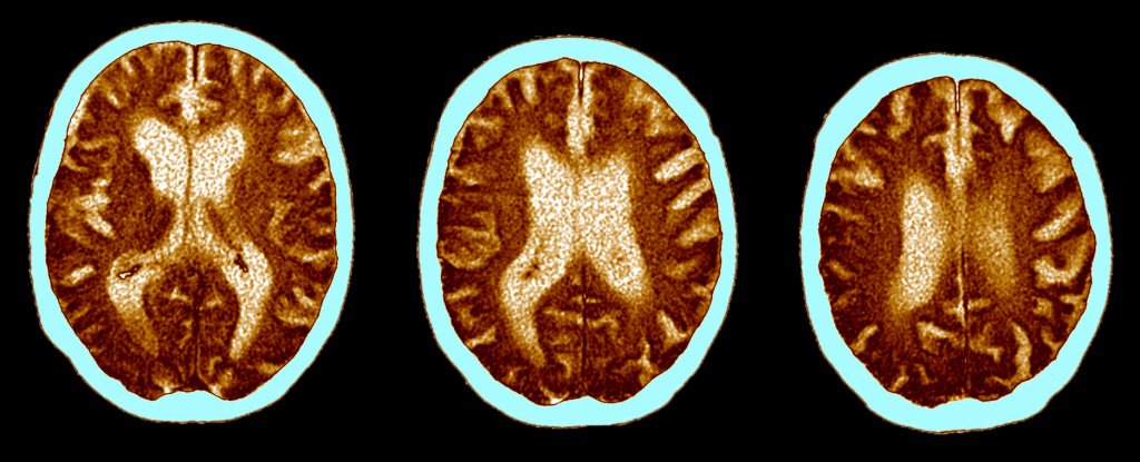 Cognitive Impact of Severe COVID Is Equivalent to 20 Years of Aging, Study Finds