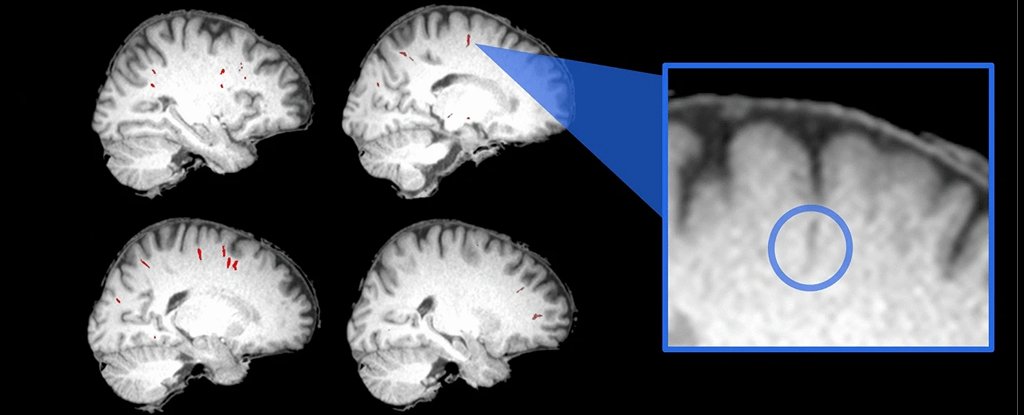 Scans showing perivascular space of a single astronaut