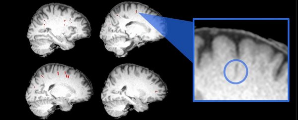 Astronauts have distinct brain changes even months after they return to Earth