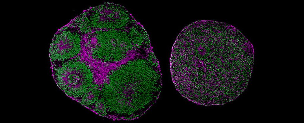 Lab-Grown Brain Experiment Reverses The Effects of Autism-Linked Gene