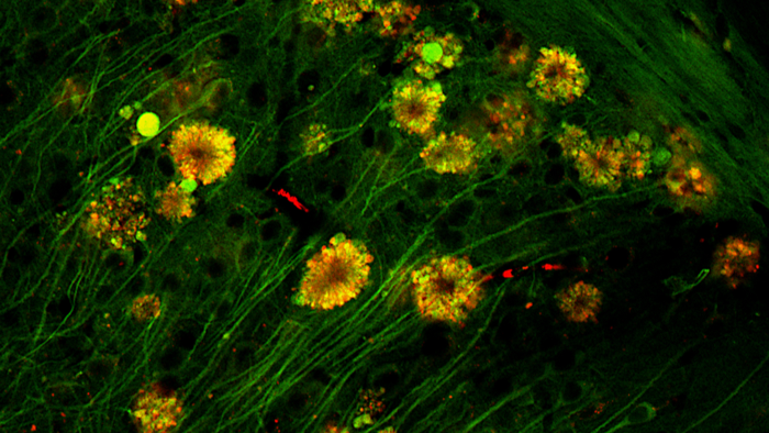 Neural 'Poisonous Flowers' Could Be The Source of Alzheimer's Plaque, Says Study