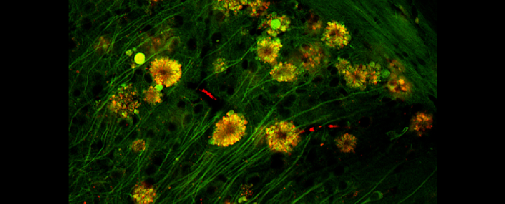 Las ‘flores venenosas’ neurales podrían ser la fuente de la placa del Alzheimer, según un estudio