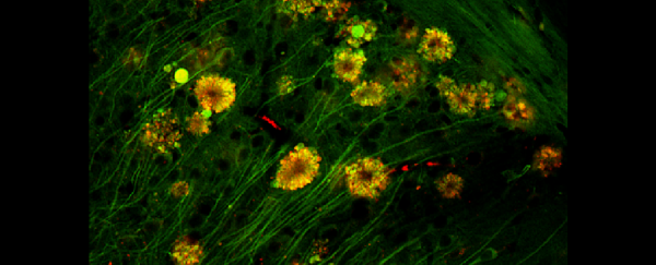 Neural 'poisonous flowers' could be the source of Alzheimer's plaque, says study