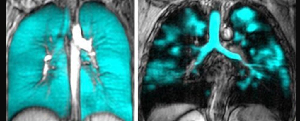 Nueva técnica de imagen revela claramente el origen de la COVID prolongada en los pulmones