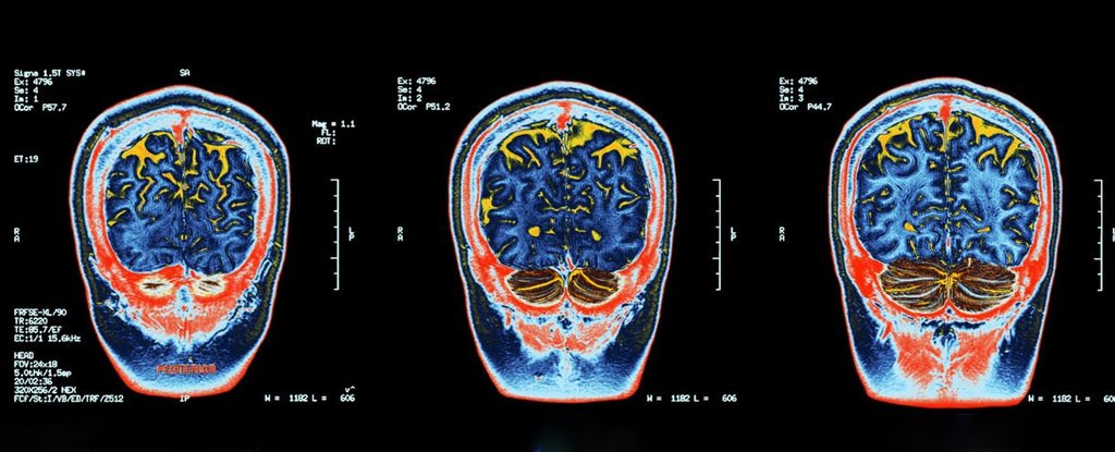 Social Isolation Actually Changes The Structure of Our Brains, Neuroimaging Reve..