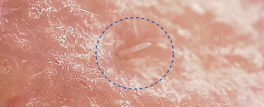 Skin Mites That Mate on Our Faces at Night Are Slowly Merging With Humans