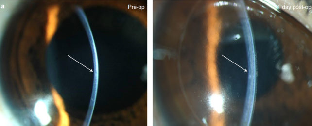 Cornea is visibly thicker one day post-operation.