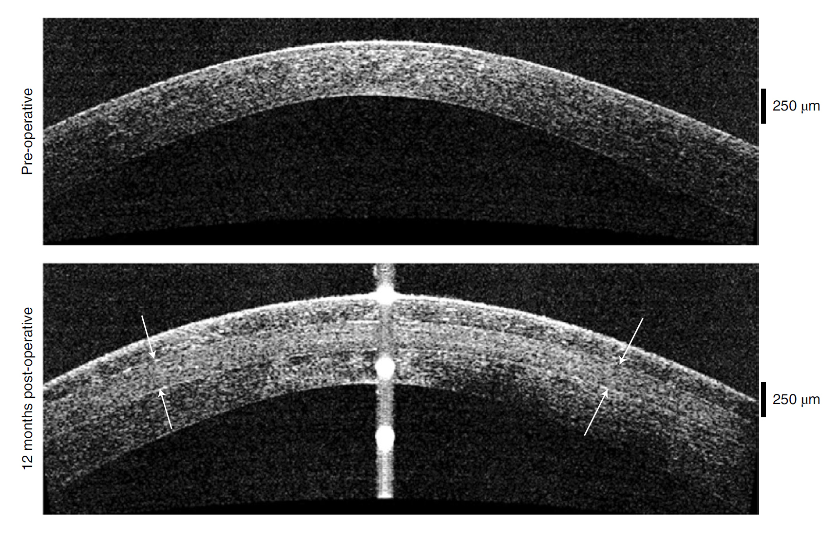 Changes in corneal thickness with arrows indicating the implant outlines post operation.