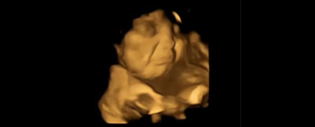 A fetus makes a 'cry-face' response.