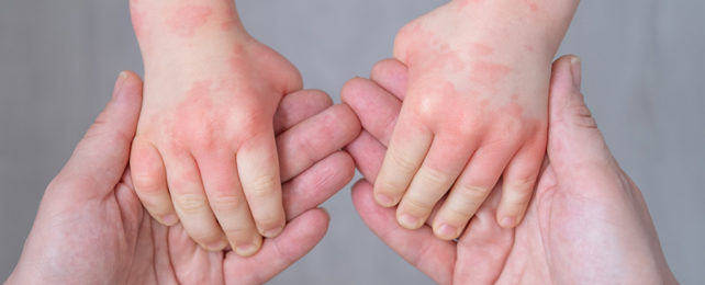 The hands of a child with eczema being held by an adult's hands