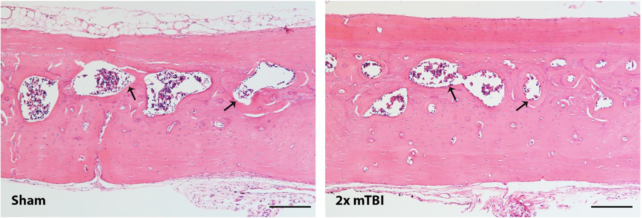 Histological tissues sections of skill bones showing shrunken bone marrow cavities.