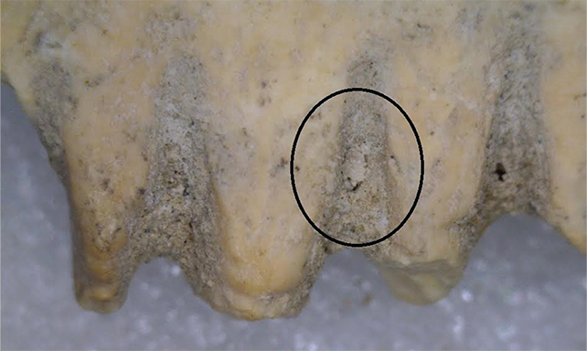 Circled head louse between the teeth of a bone comb