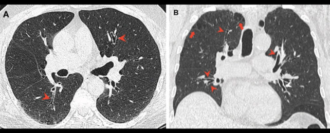 Two cross-sectional chest CT images showing lung damage in 66-year-old smoker.
