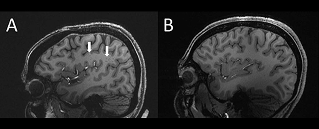 Cambios misteriosos identificados en los cerebros de las personas que tienen migrañas : Heaven32