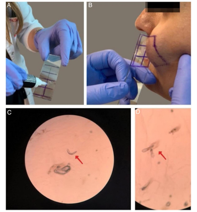 Four images showing a skin biopsy taken from a face, a scientist's hands holding a skin biopsy on a slide, then two microscope images of Demodex mites on the skin.