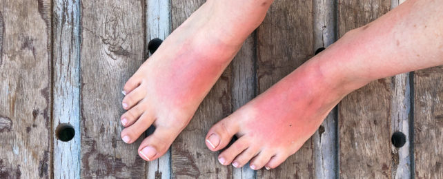 Looking down at sunburnt feet standing on wooden boardwalk