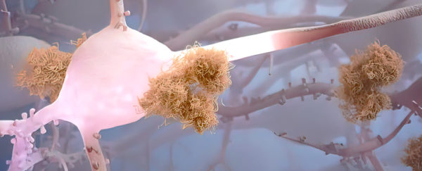 New Blood Test Accurately Predicts Alzheimer's Years Ahead of First ...