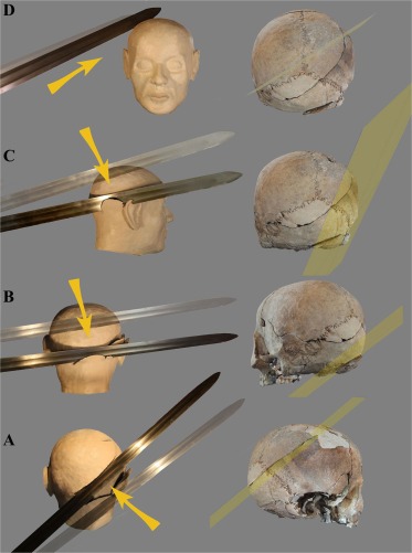 Skull Injuries in Medieval Man