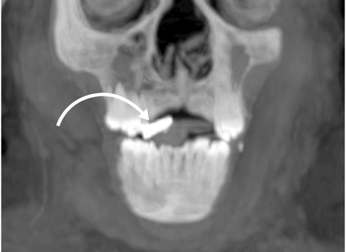 CT scan of gold amulet in mouth of mummy.