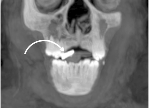 CT scan d'amulette d'or dans la bouche de maman.