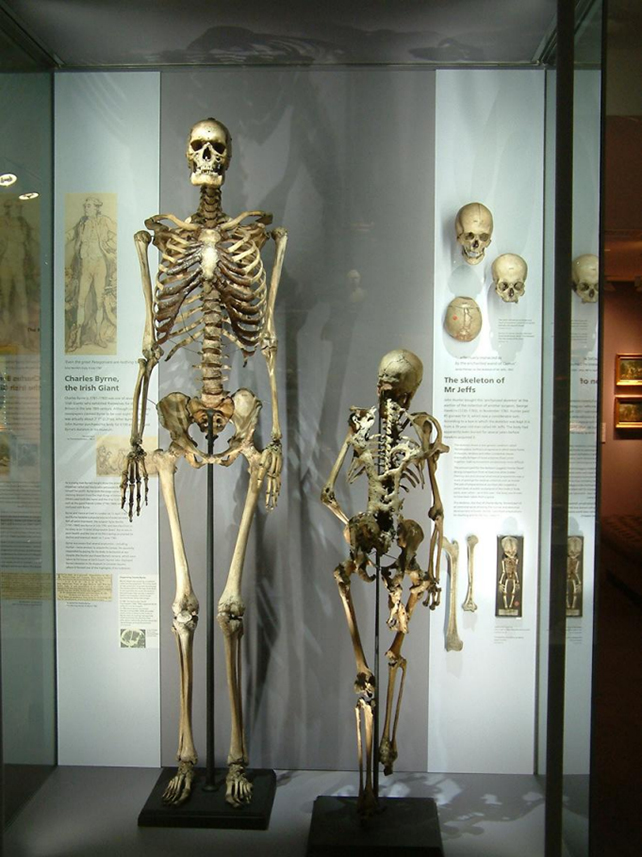 Charles Byrne skeleton