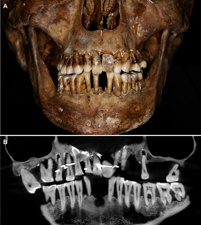 Bir kafatasındaki dişlerin bir fotoğrafı ve bunun altında, dişlerin ve kafatasının röntgeni bir teli gösteriyor.