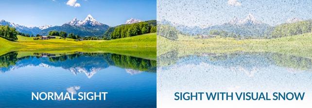 Graphic showing what visual-snow syndrome looks like, comparing a blue and green outdoor image with normal vision on the right, and seen with Visual -snow syndrome on the left