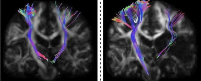 Brain scans showing damaged nerves