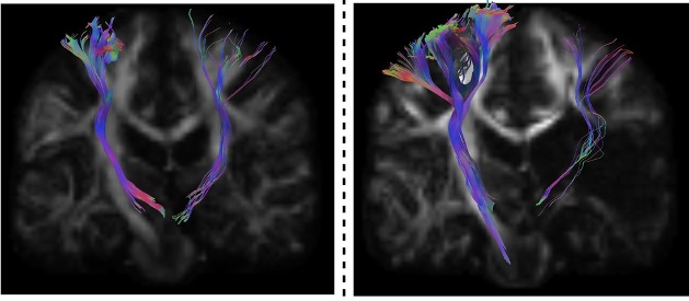 Images of spinal cord showing nerve fibres damaged by stroke.
