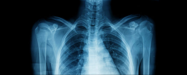 X-ray of a human chest