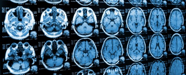MRI Scans Of Brain
