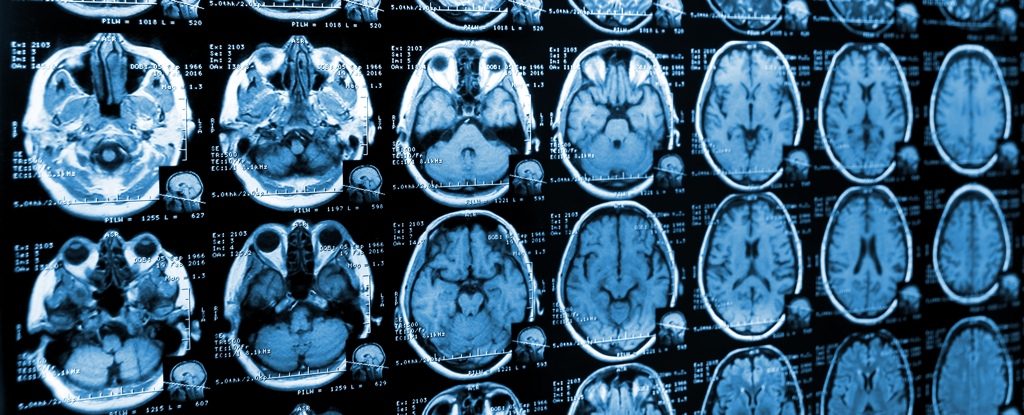 La adicción a la cocaína hace que el cerebro humano “envejezca” más rápido, advierten los científicos : Heaven32