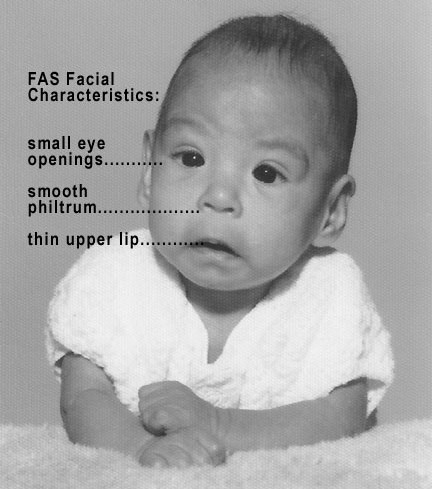 a baby with fetal alcohol syndrome