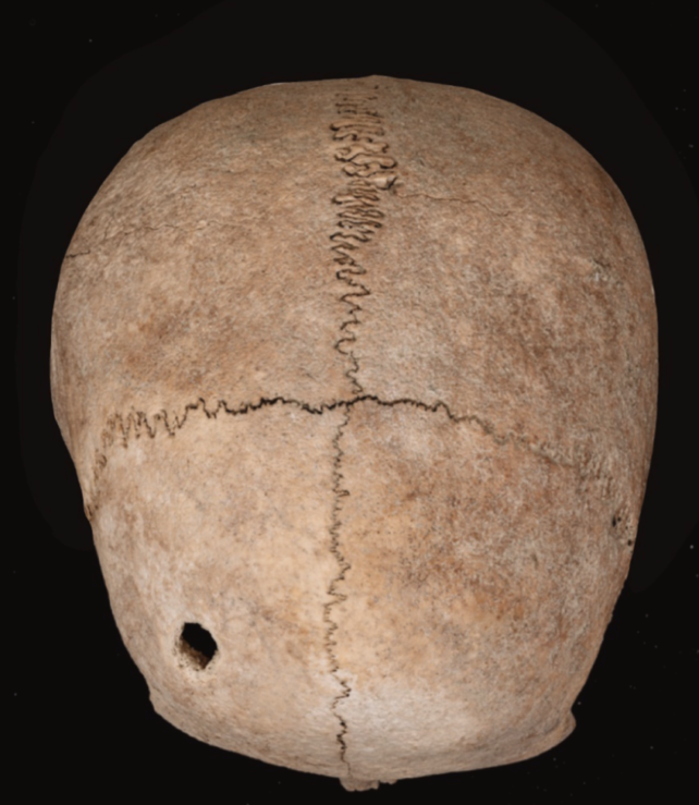 Lesion in ancient skull