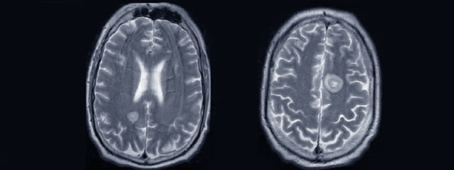 MRI of brain with lesion