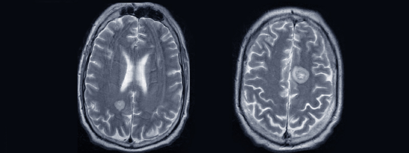 MRI of brain with lesion